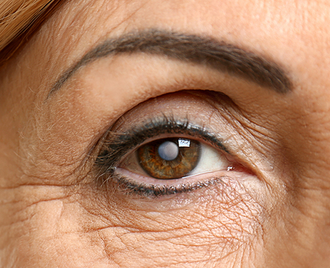 Cataract Cataract