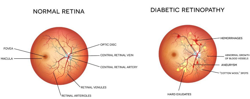 Diabetic Retinopathy Diabetic Retinopathy